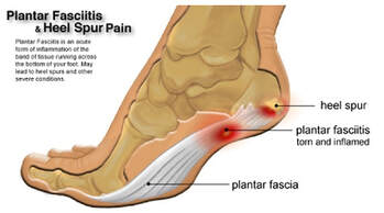 The Ultimate Guide to Plantar Fasciitis Treatment, symptoms and